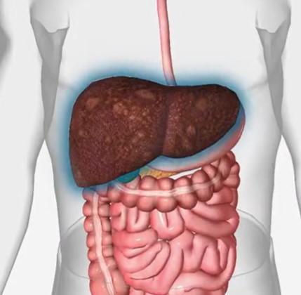 Hepatitis A